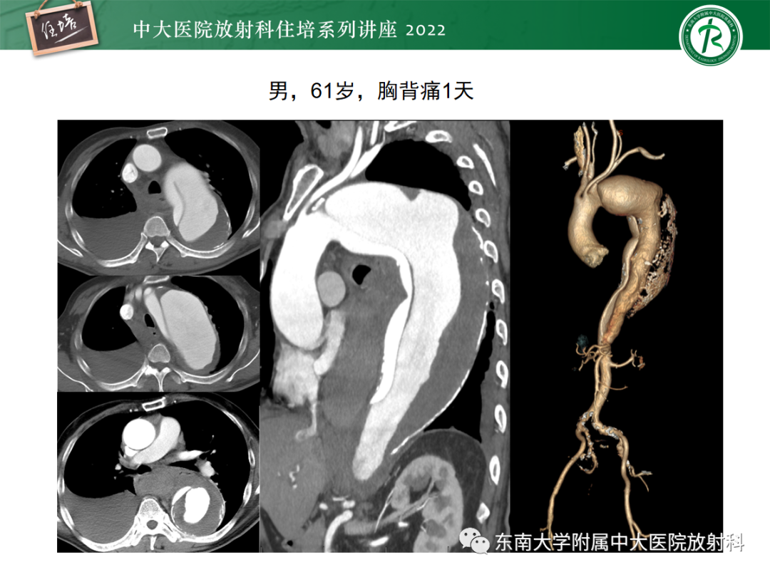 影像PPT - 【PPT】影像急诊易漏诊病变总结-36