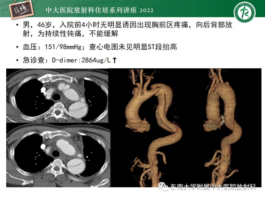 影像PPT - 【PPT】影像急诊易漏诊病变总结-37