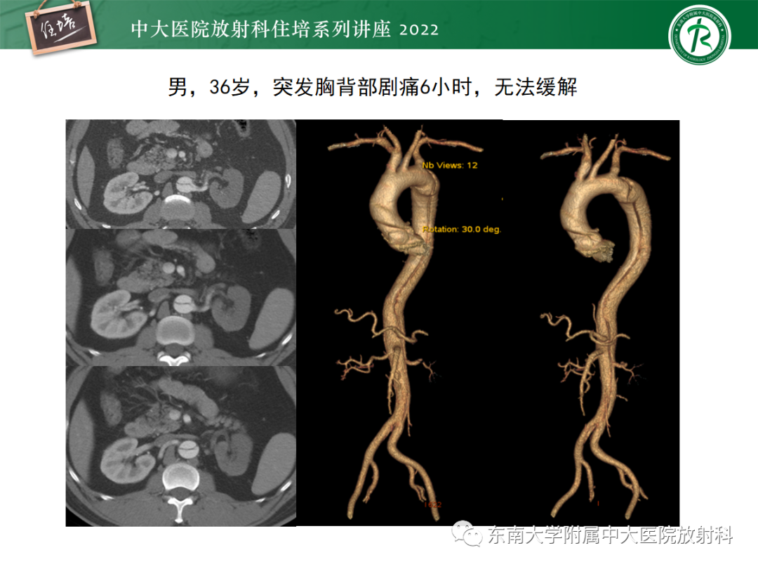 影像PPT - 【PPT】影像急诊易漏诊病变总结-39