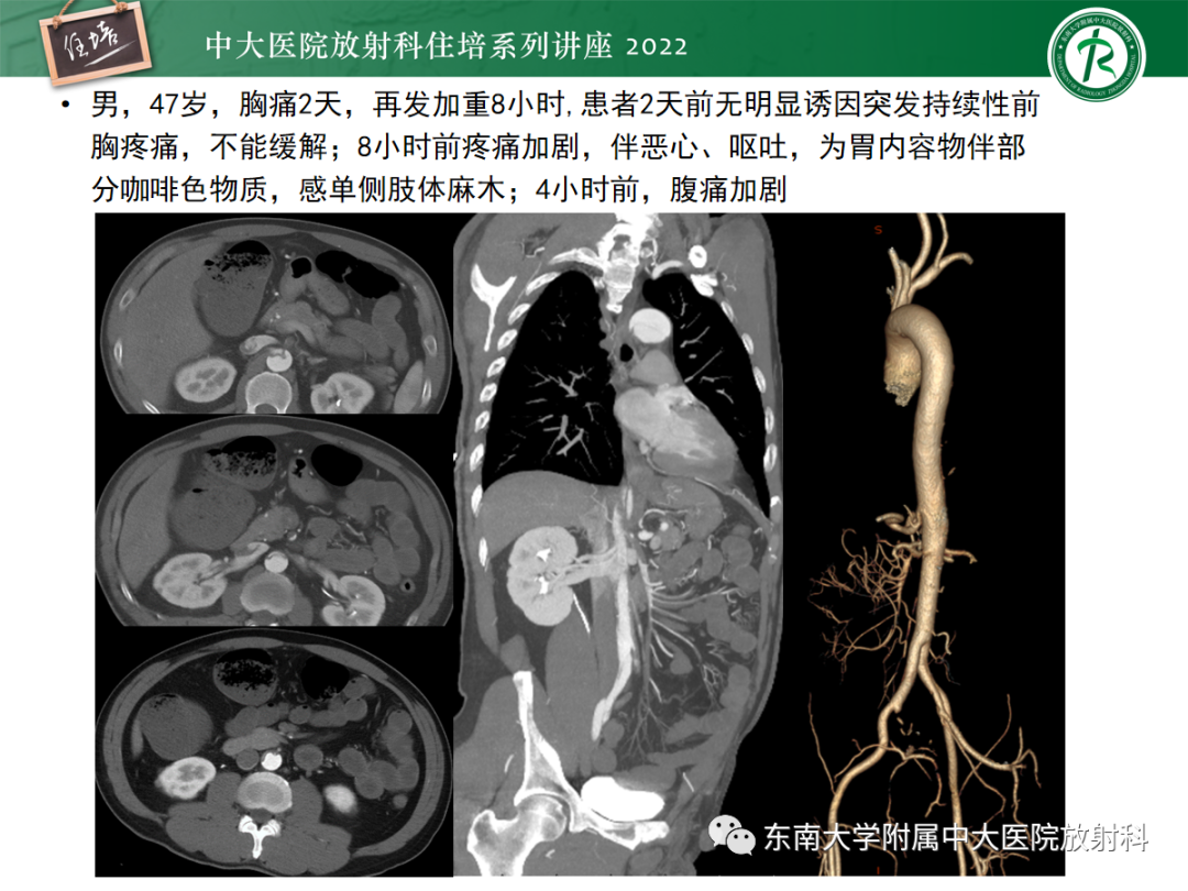影像PPT - 【PPT】影像急诊易漏诊病变总结-40