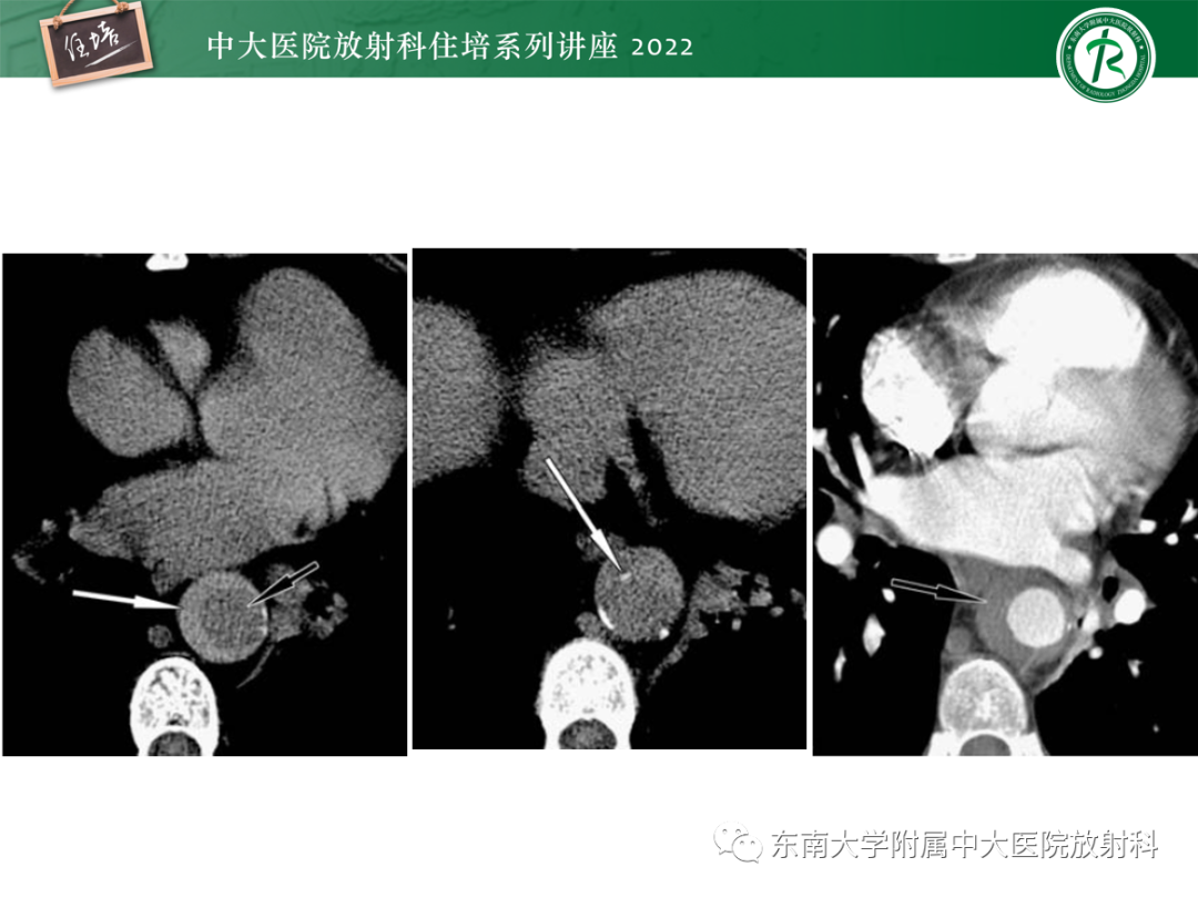 影像PPT - 【PPT】影像急诊易漏诊病变总结-42