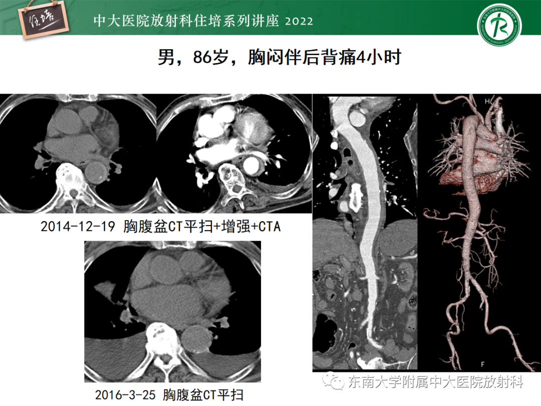 影像PPT - 【PPT】影像急诊易漏诊病变总结-46