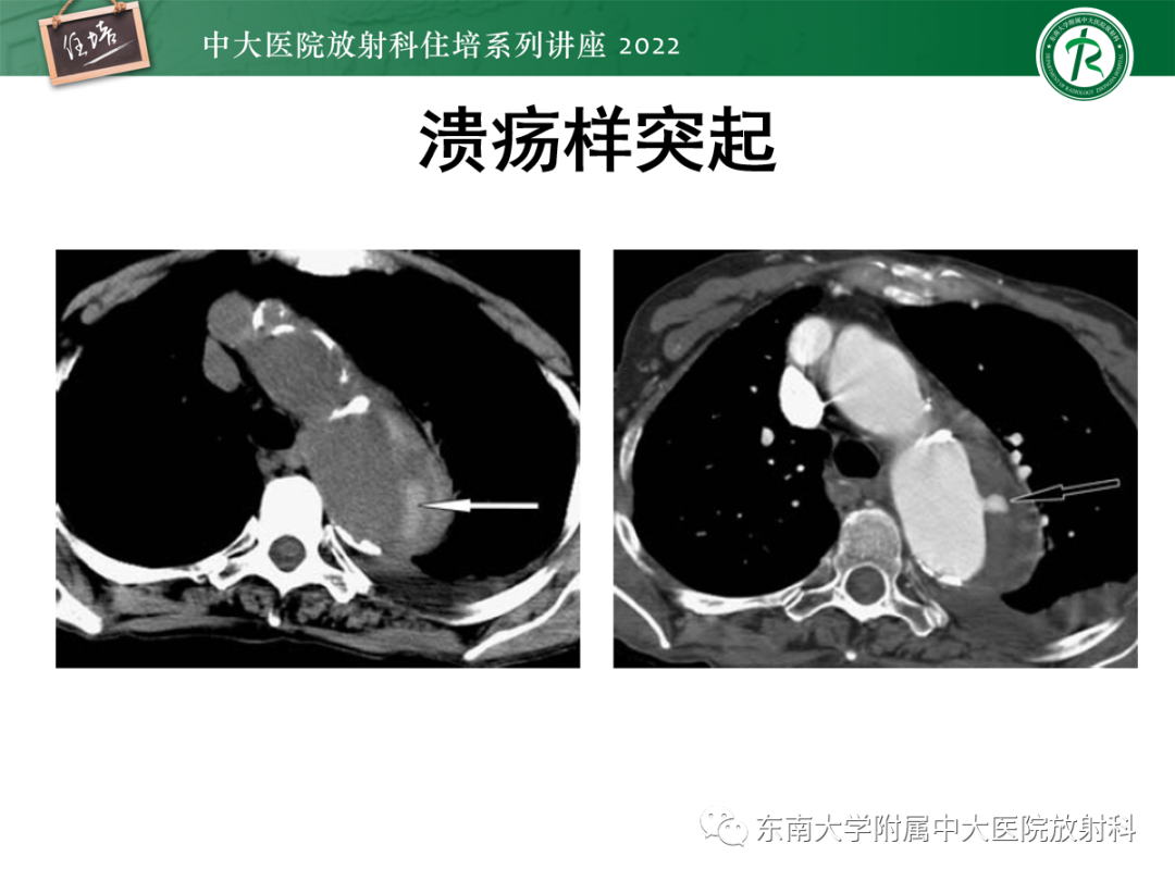 影像PPT - 【PPT】影像急诊易漏诊病变总结-48