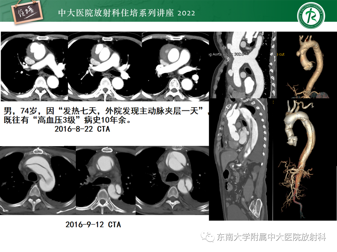 影像PPT - 【PPT】影像急诊易漏诊病变总结-49