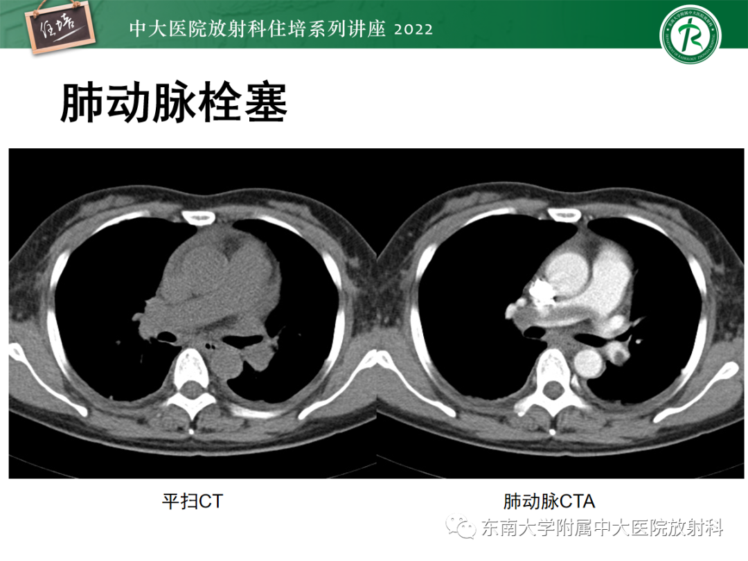 影像PPT - 【PPT】影像急诊易漏诊病变总结-50