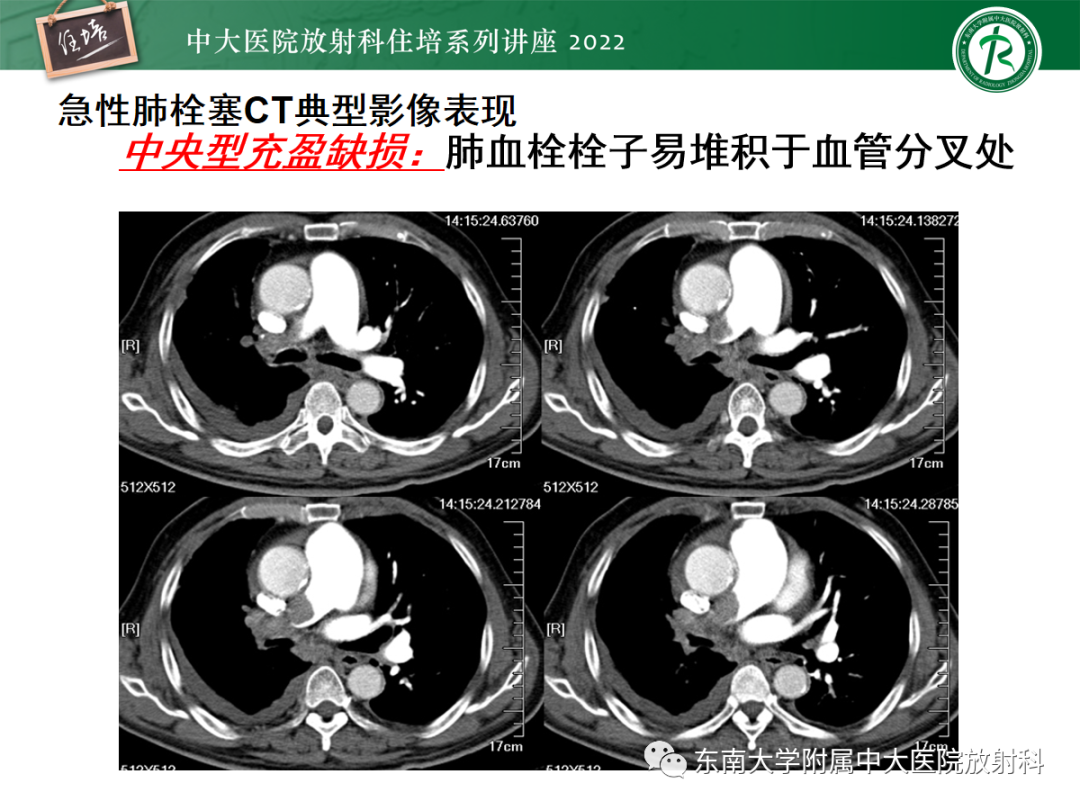 影像PPT - 【PPT】影像急诊易漏诊病变总结-52