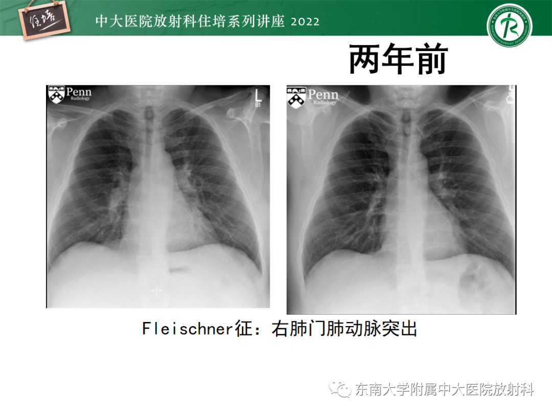 影像PPT - 【PPT】影像急诊易漏诊病变总结-55