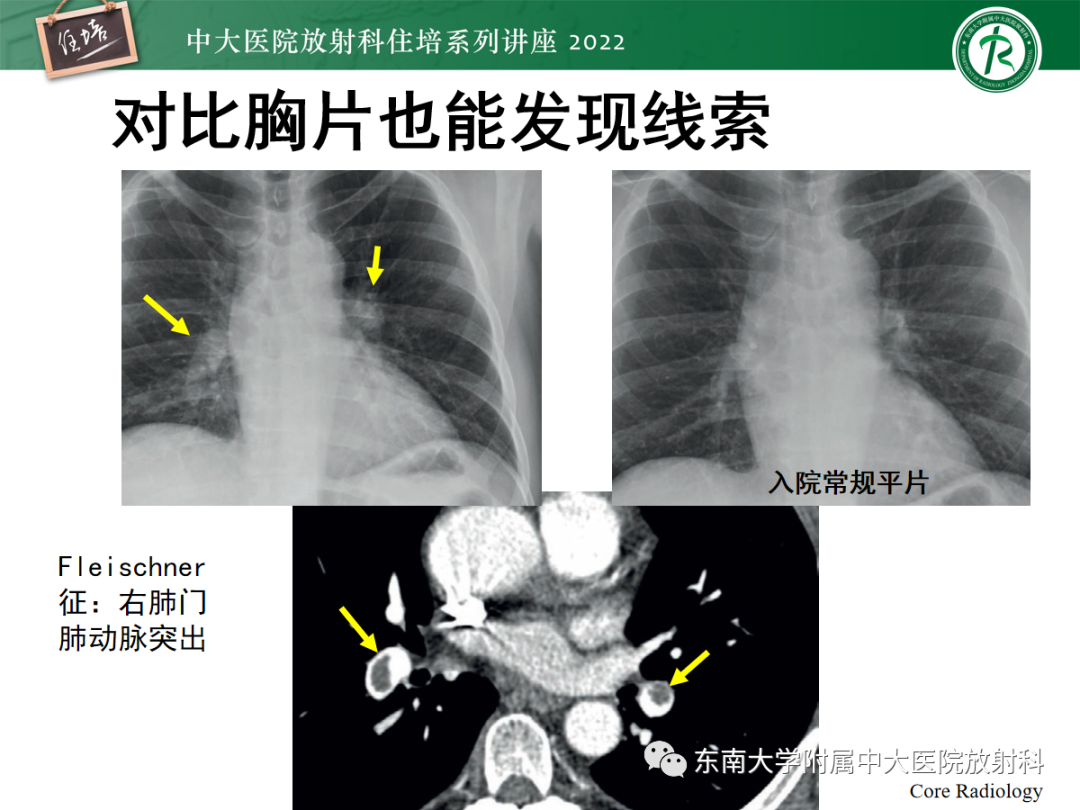 影像PPT - 【PPT】影像急诊易漏诊病变总结-54