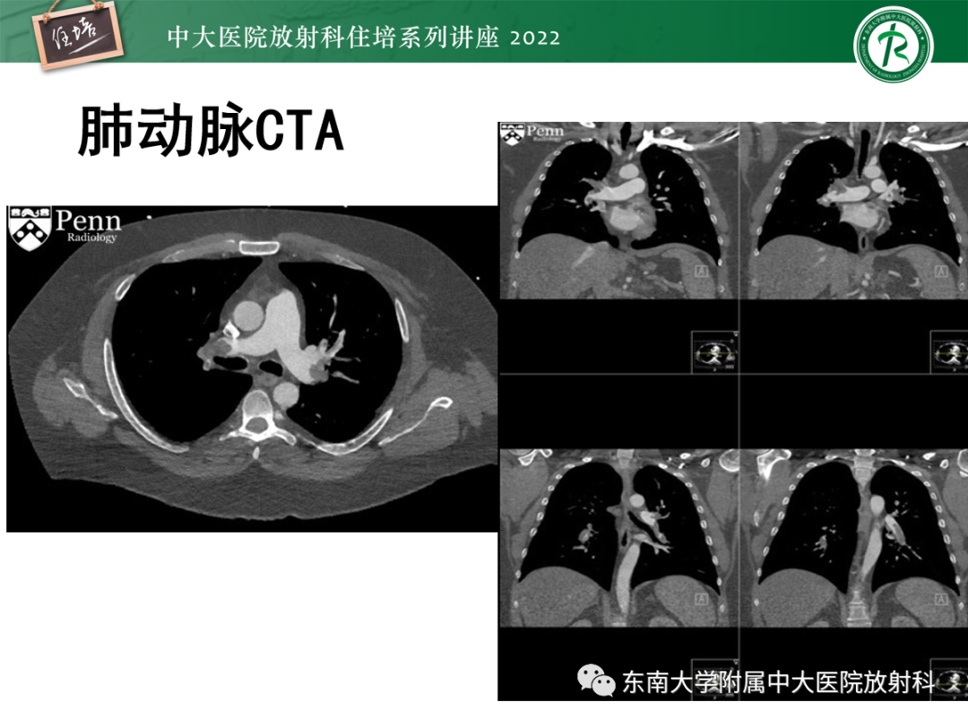 影像PPT - 【PPT】影像急诊易漏诊病变总结-56