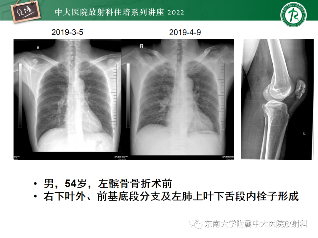 影像PPT - 【PPT】影像急诊易漏诊病变总结-57