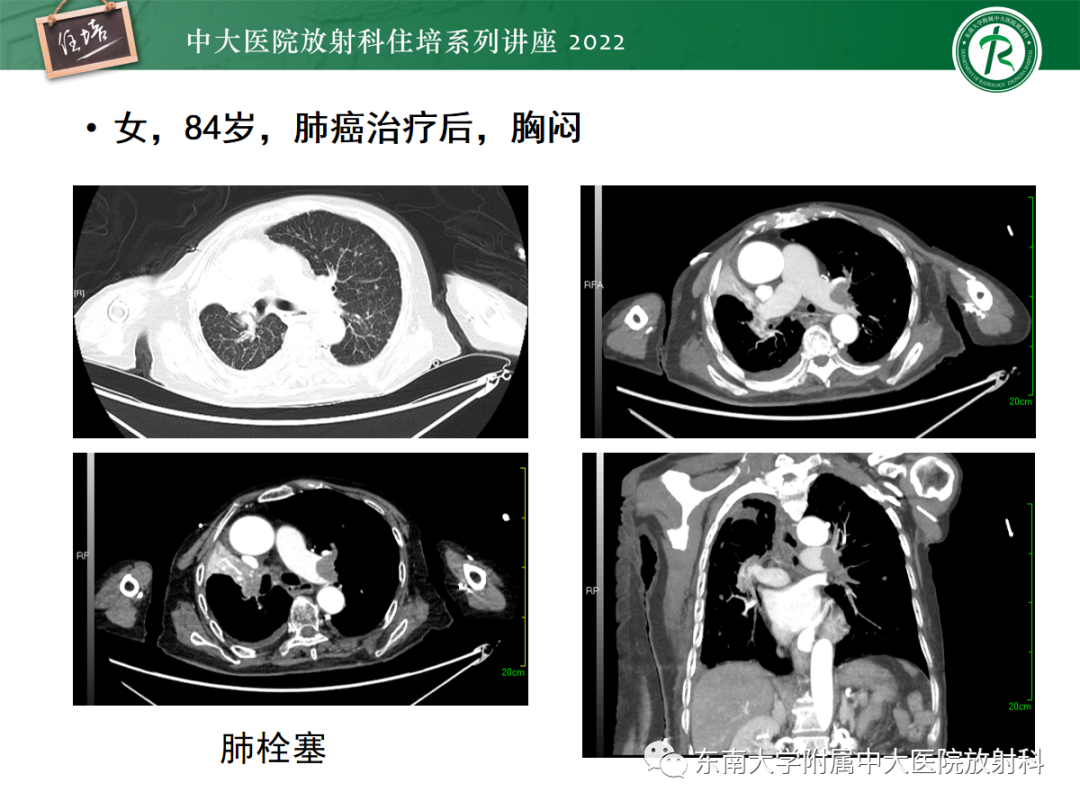 影像PPT - 【PPT】影像急诊易漏诊病变总结-59