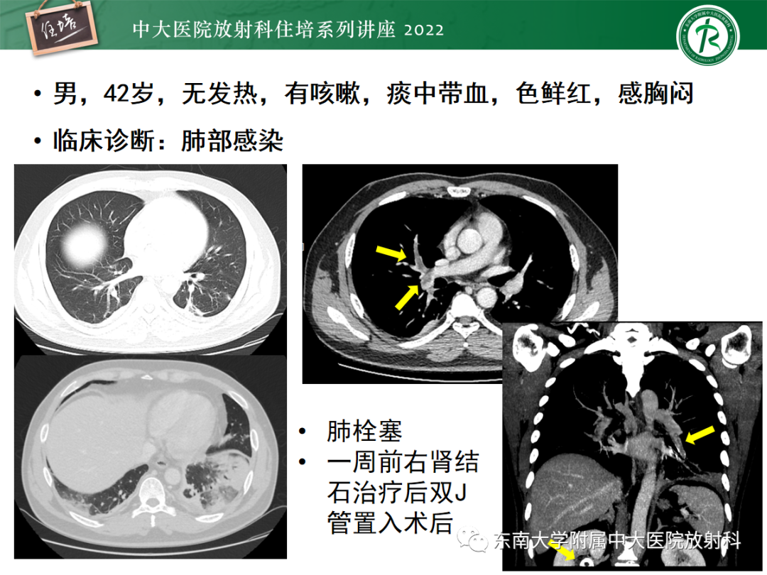 影像PPT - 【PPT】影像急诊易漏诊病变总结-60