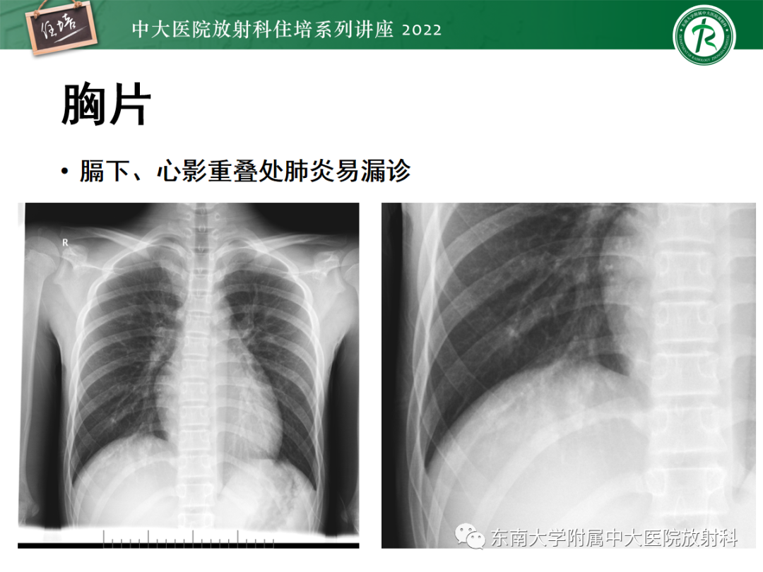 影像PPT - 【PPT】影像急诊易漏诊病变总结-62