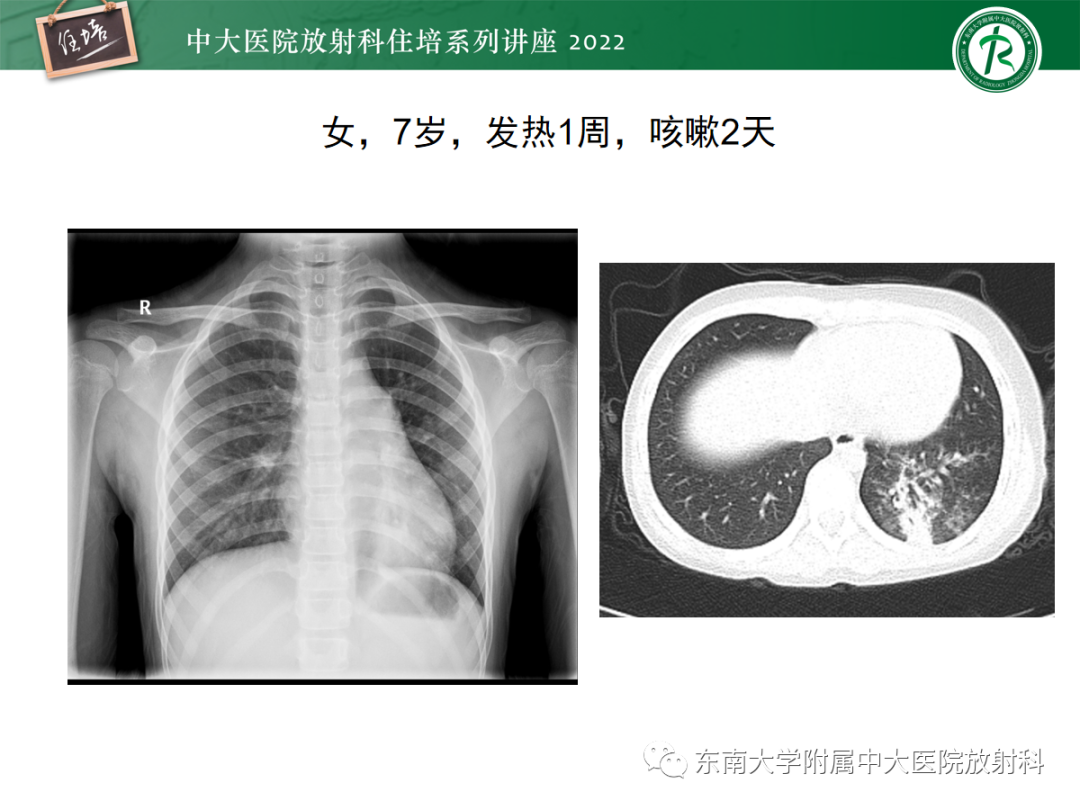 影像PPT - 【PPT】影像急诊易漏诊病变总结-63