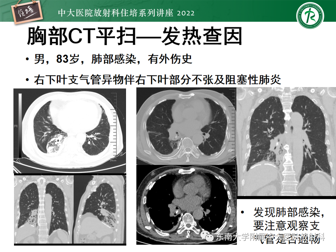 影像PPT - 【PPT】影像急诊易漏诊病变总结-65