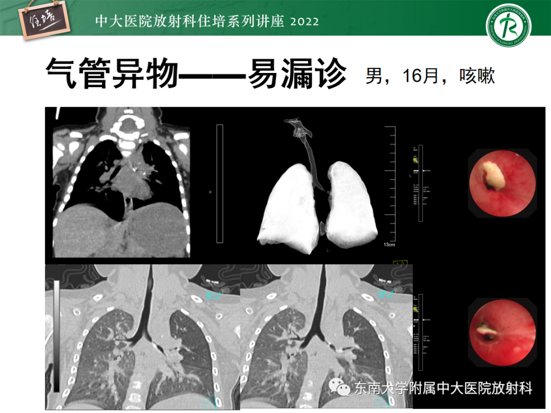 影像PPT - 【PPT】影像急诊易漏诊病变总结-64