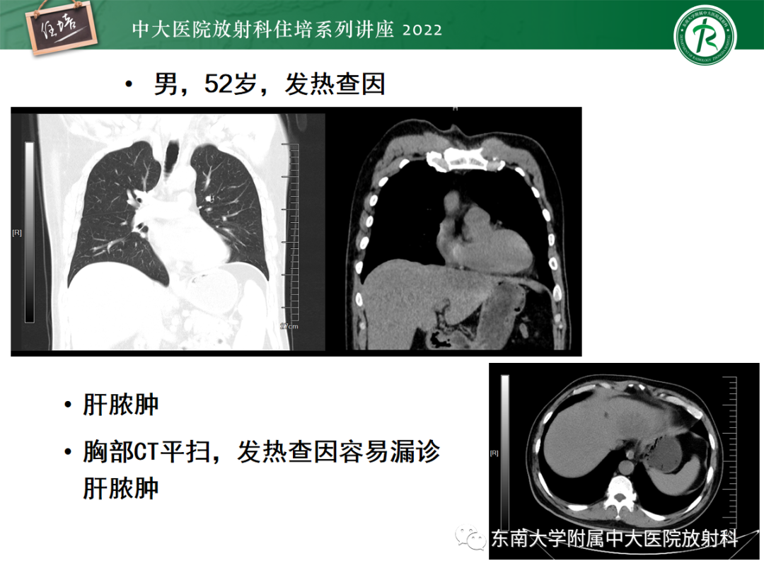 影像PPT - 【PPT】影像急诊易漏诊病变总结-66