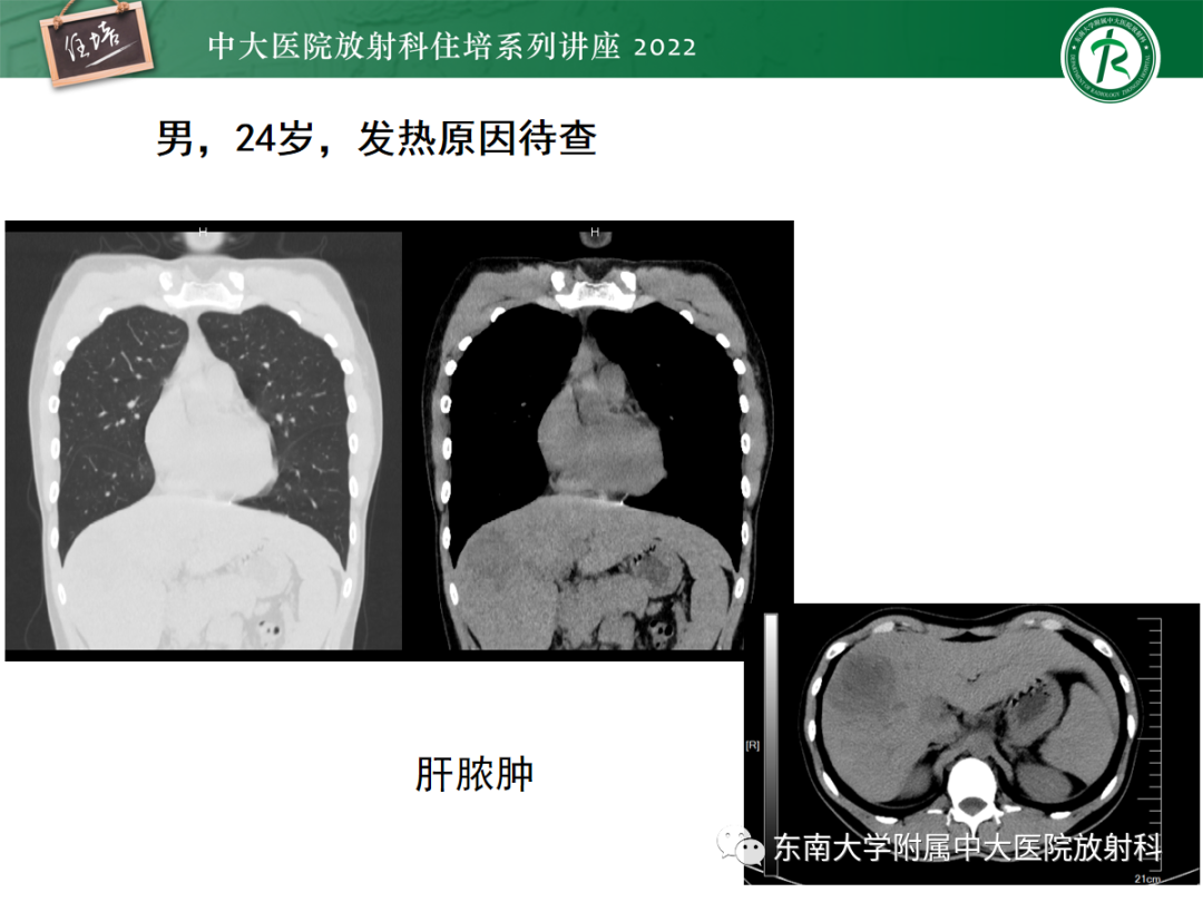 影像PPT - 【PPT】影像急诊易漏诊病变总结-67