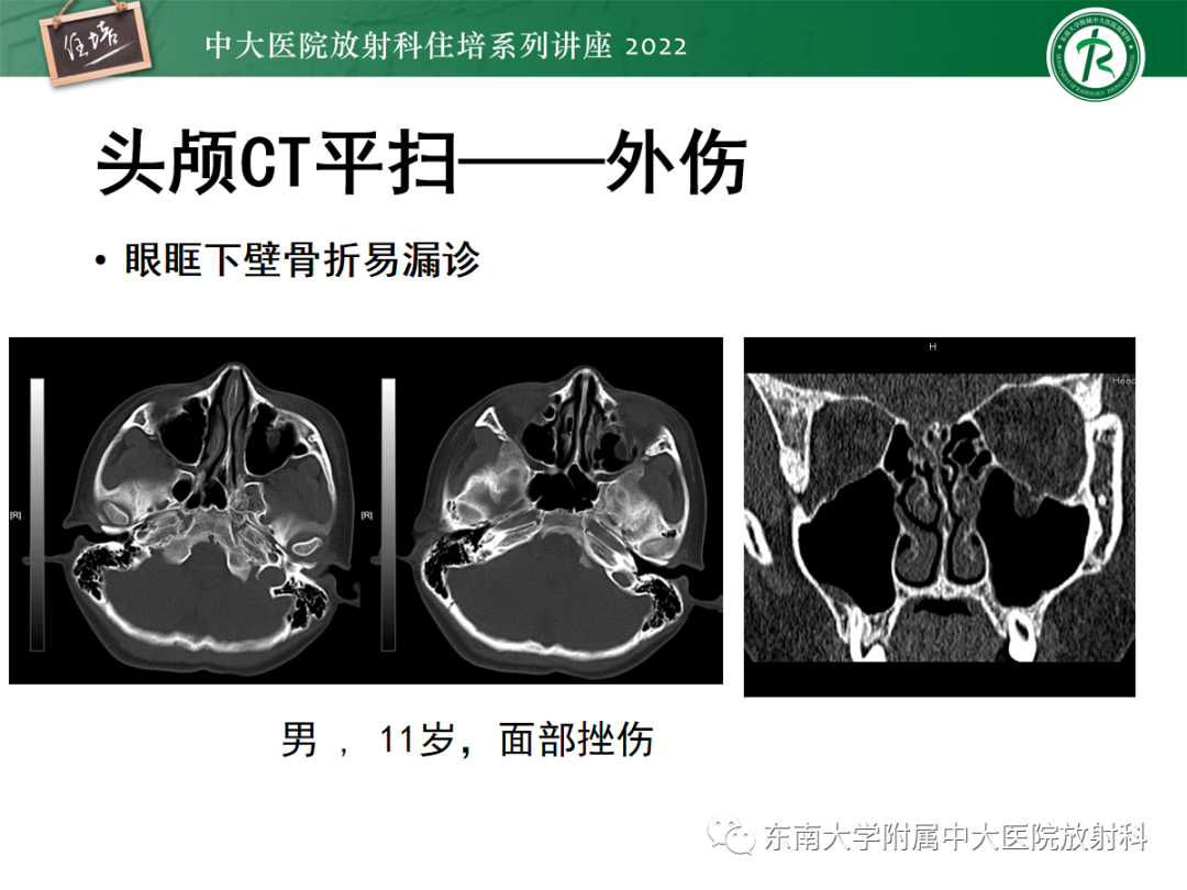 影像PPT - 【PPT】影像急诊易漏诊病变总结-69
