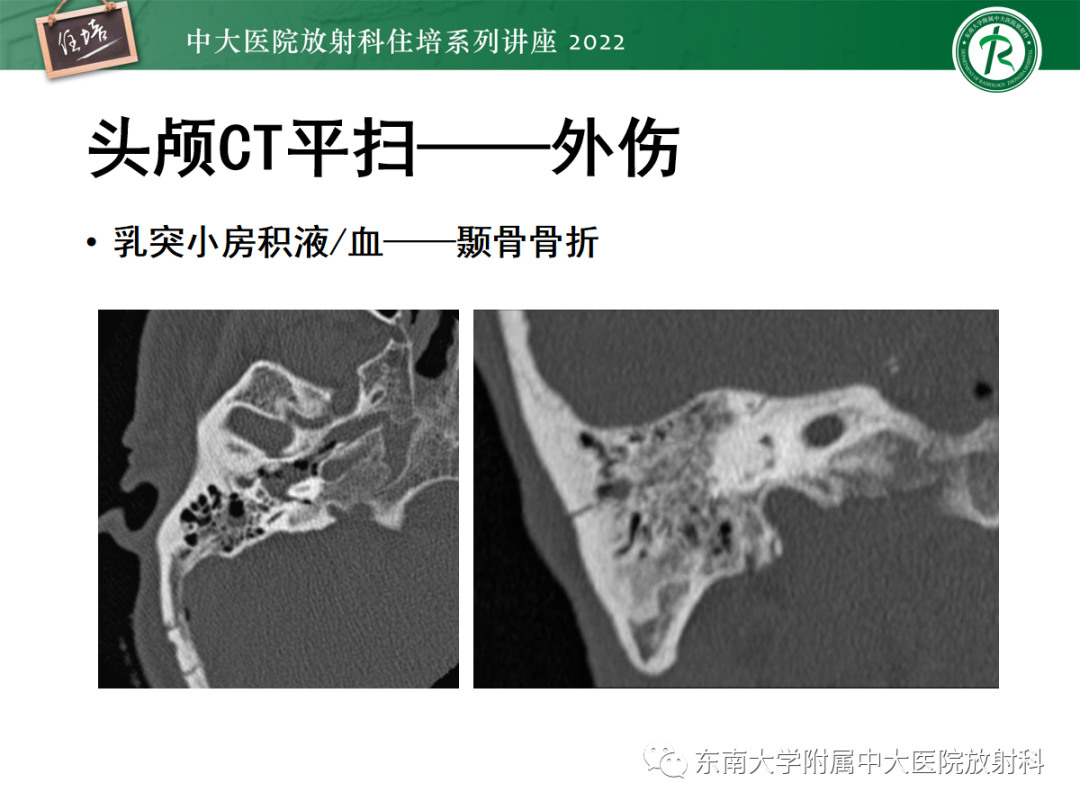 影像PPT - 【PPT】影像急诊易漏诊病变总结-72