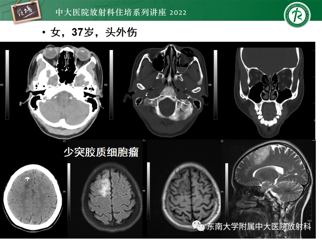 影像PPT - 【PPT】影像急诊易漏诊病变总结-70