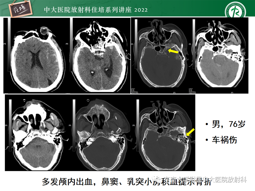影像PPT - 【PPT】影像急诊易漏诊病变总结-71