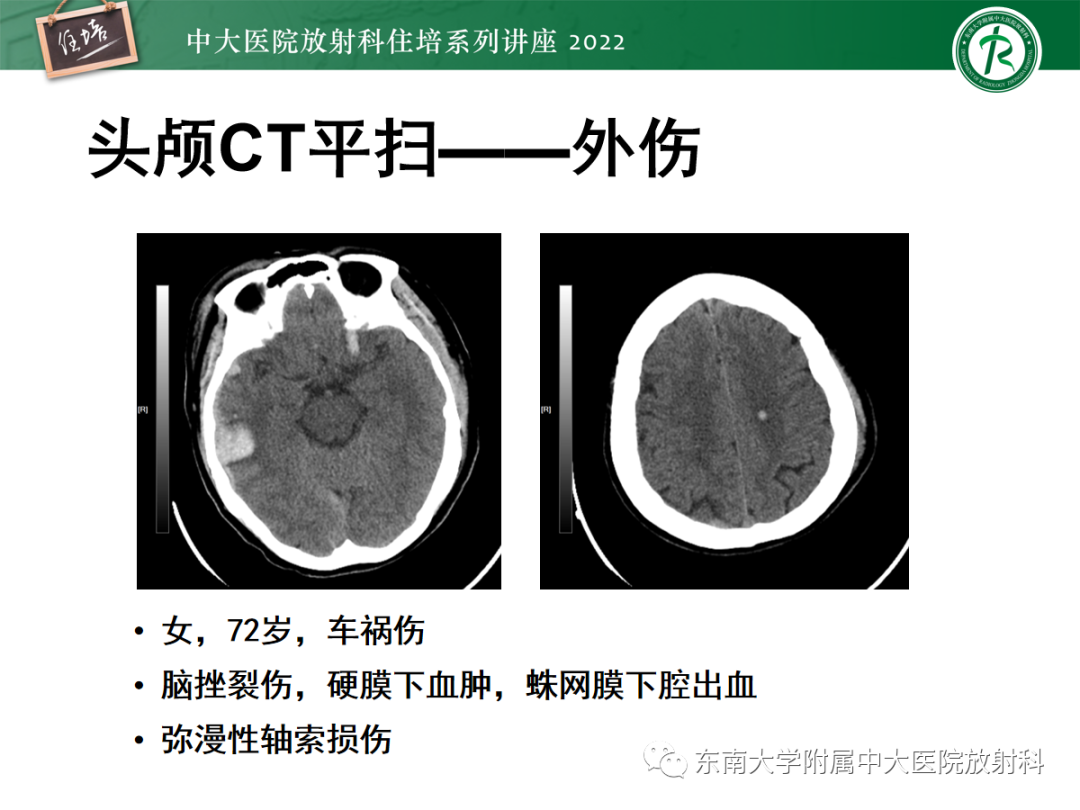 影像PPT - 【PPT】影像急诊易漏诊病变总结-73