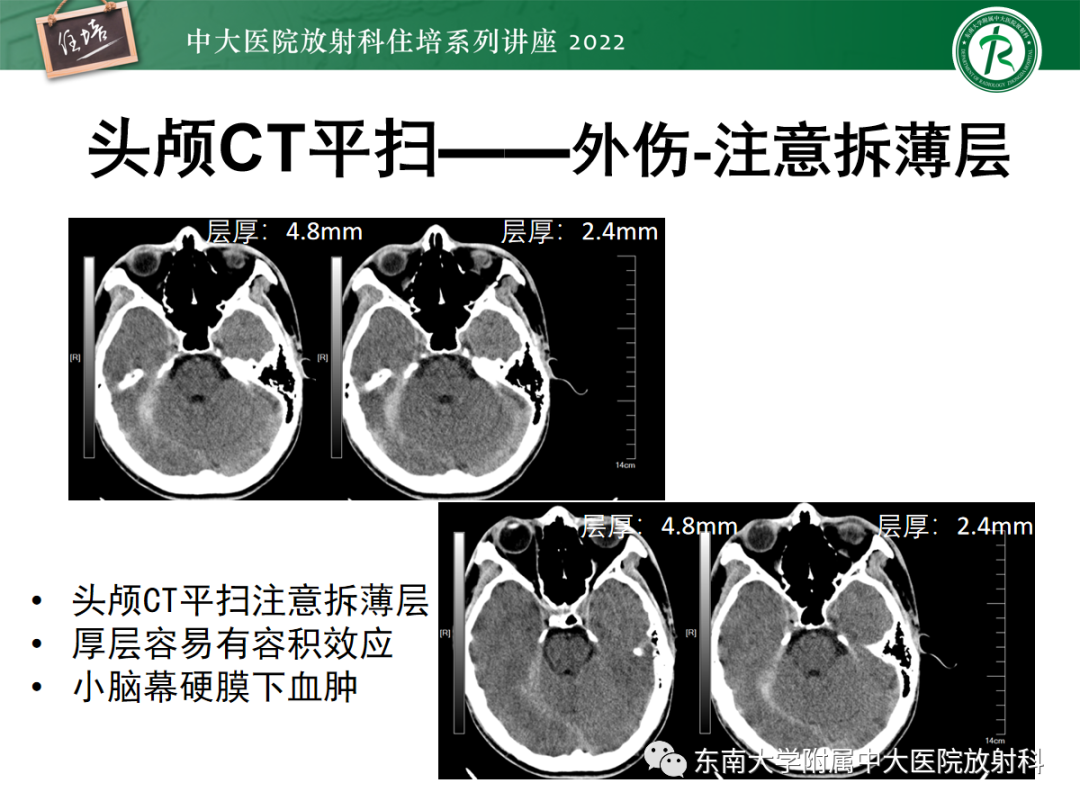 影像PPT - 【PPT】影像急诊易漏诊病变总结-74