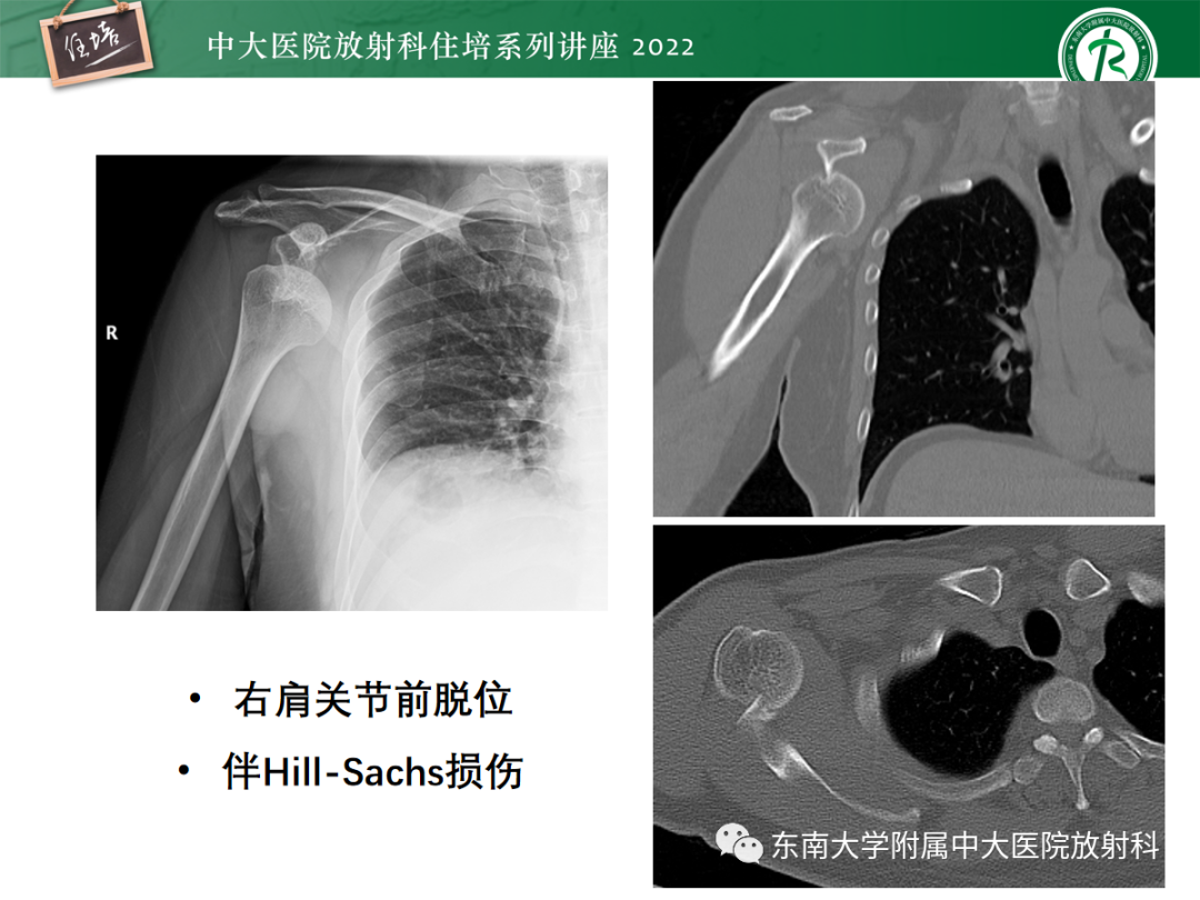 影像PPT - 【PPT】影像急诊易漏诊病变总结-77