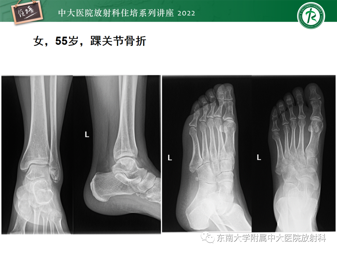 影像PPT - 【PPT】影像急诊易漏诊病变总结-76