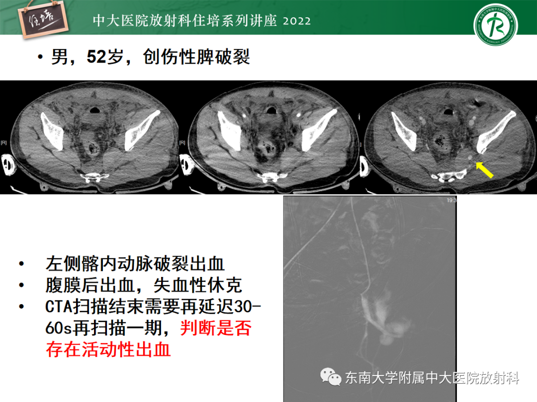 影像PPT - 【PPT】影像急诊易漏诊病变总结-79