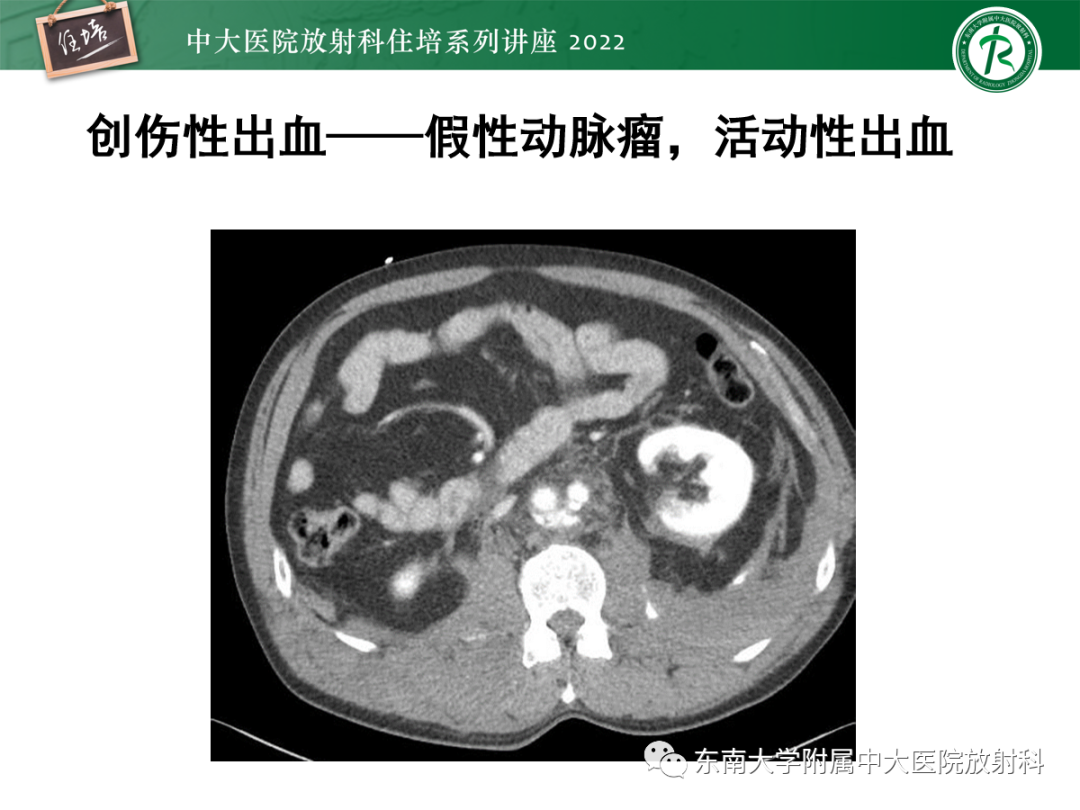 影像PPT - 【PPT】影像急诊易漏诊病变总结-80