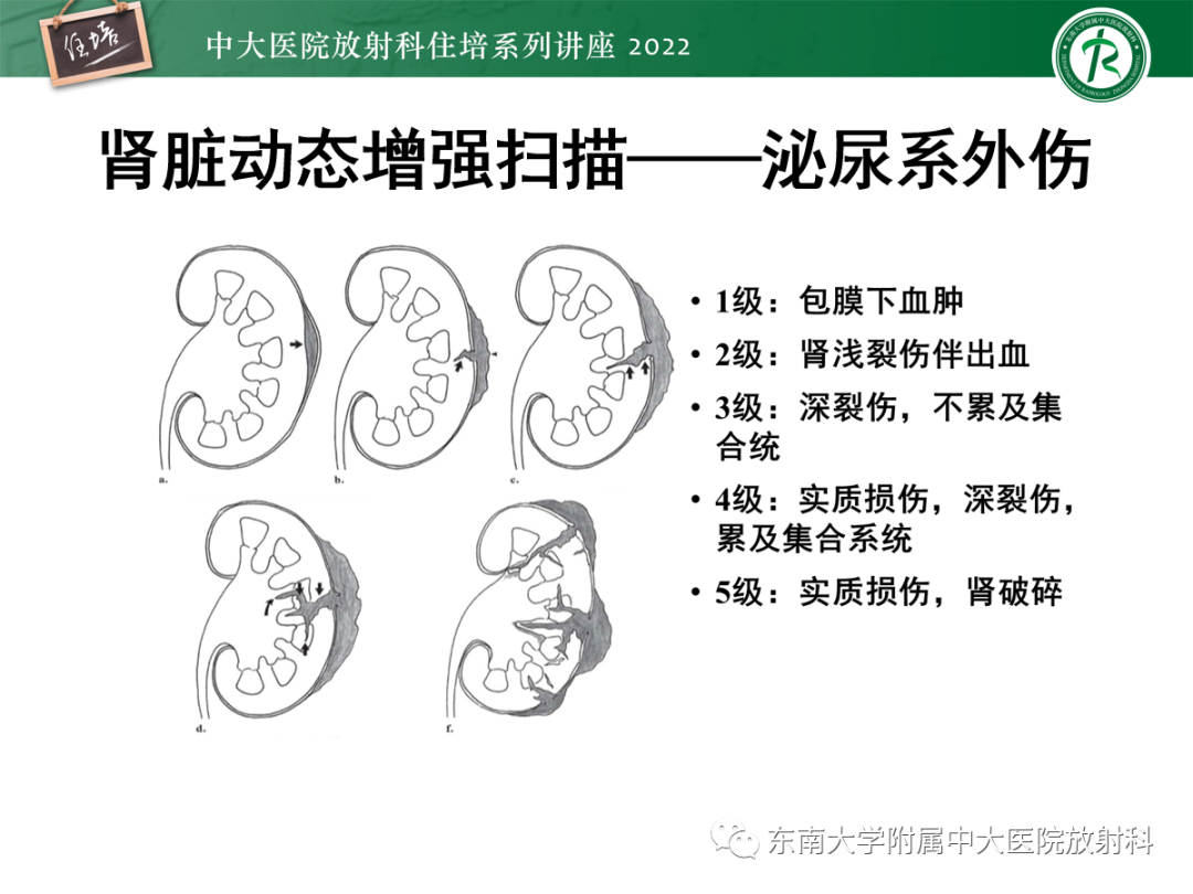 影像PPT - 【PPT】影像急诊易漏诊病变总结-82