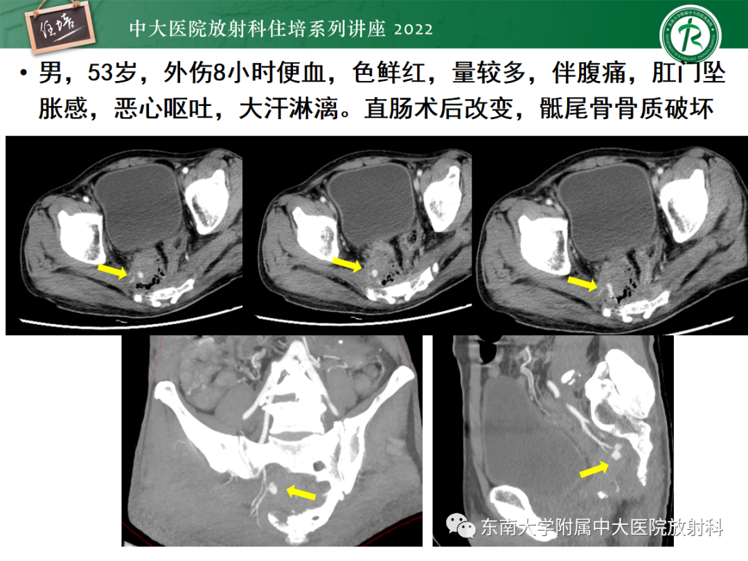 影像PPT - 【PPT】影像急诊易漏诊病变总结-81