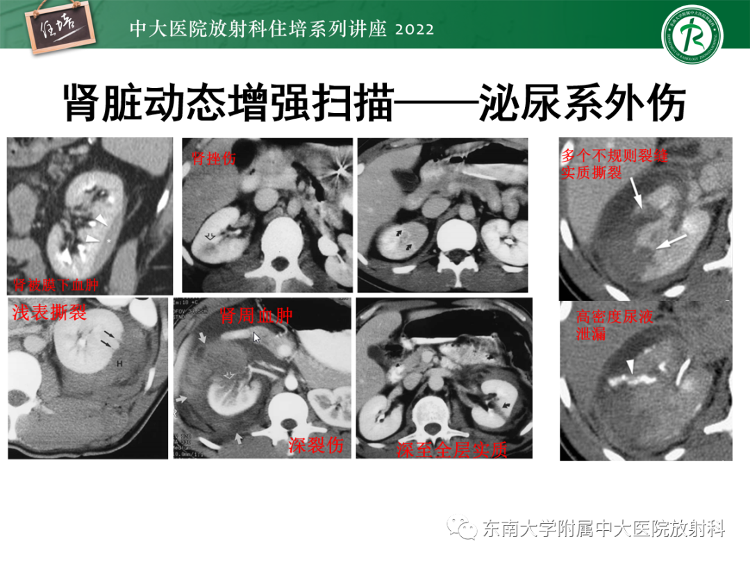 影像PPT - 【PPT】影像急诊易漏诊病变总结-83