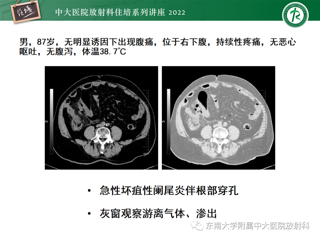 影像PPT - 【PPT】影像急诊易漏诊病变总结-86