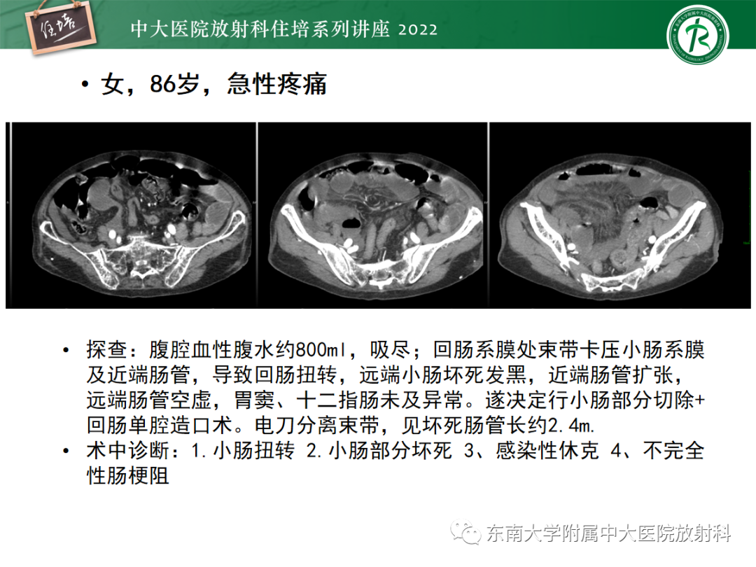 影像PPT - 【PPT】影像急诊易漏诊病变总结-87