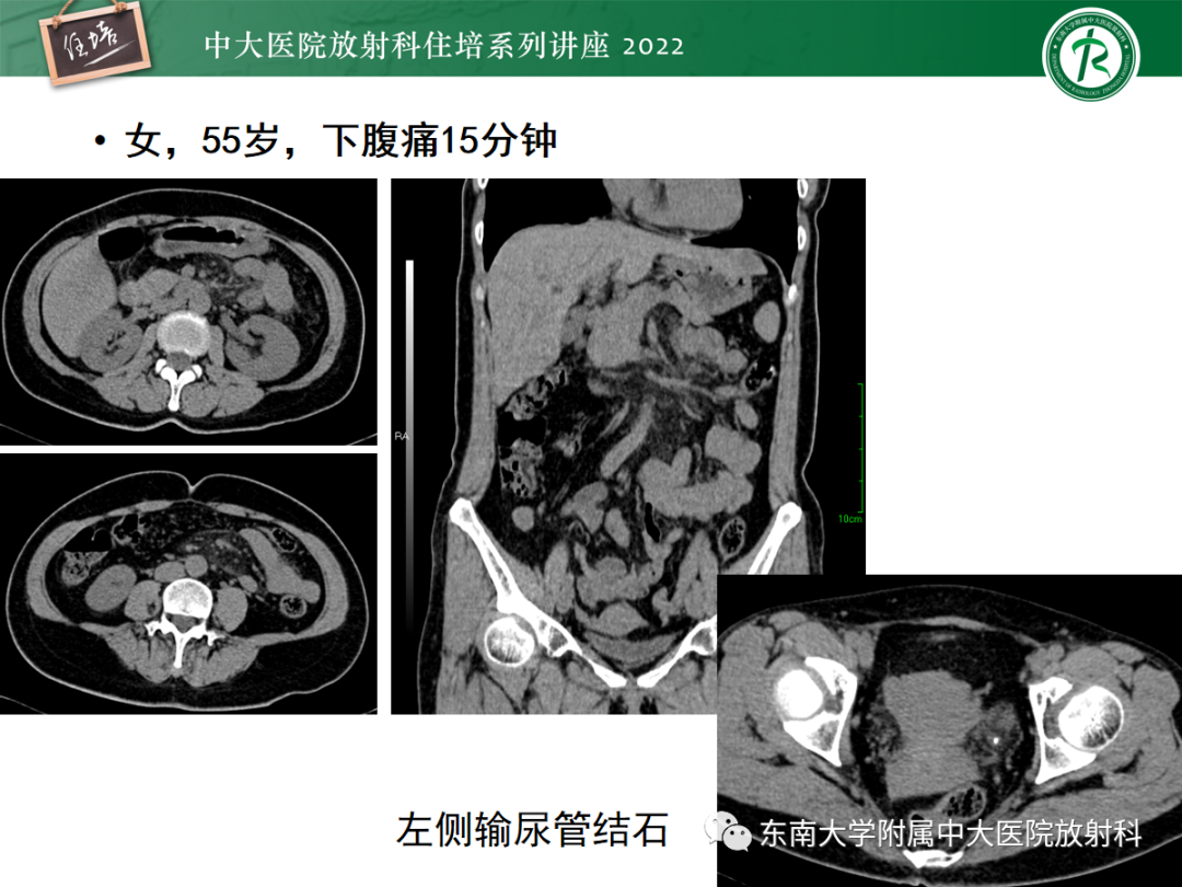 影像PPT - 【PPT】影像急诊易漏诊病变总结-88