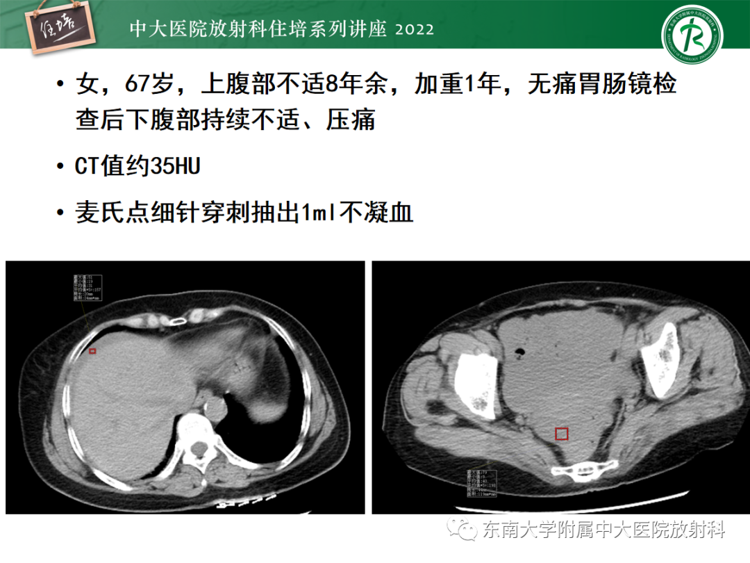影像PPT - 【PPT】影像急诊易漏诊病变总结-91