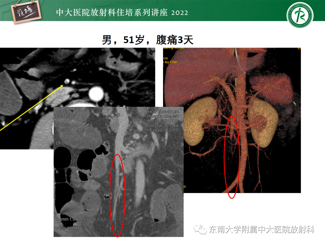影像PPT - 【PPT】影像急诊易漏诊病变总结-90