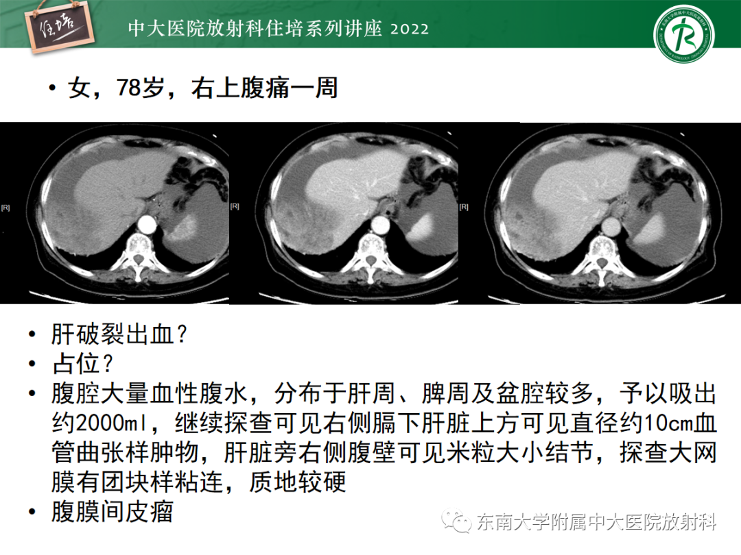 影像PPT - 【PPT】影像急诊易漏诊病变总结-92