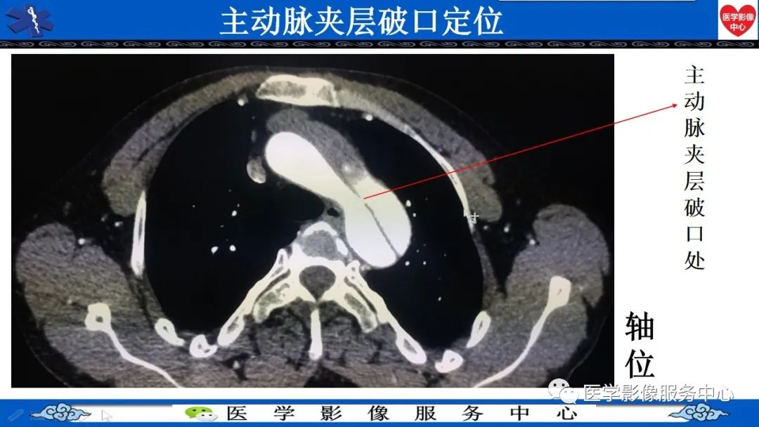 影像PPT - 【PPT】CTA诊断主动脉夹层的内容和征象-4