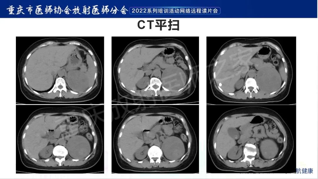 影像PPT - 【病例】肾上腺皮质嗜酸细胞腺瘤1例CT-3