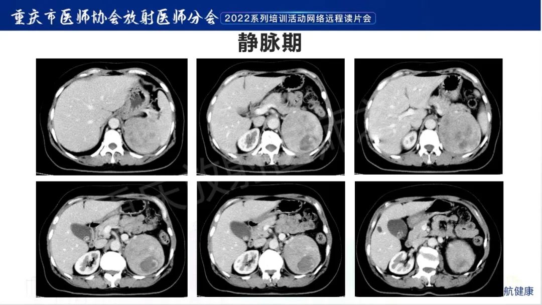 影像PPT - 【病例】肾上腺皮质嗜酸细胞腺瘤1例CT-5