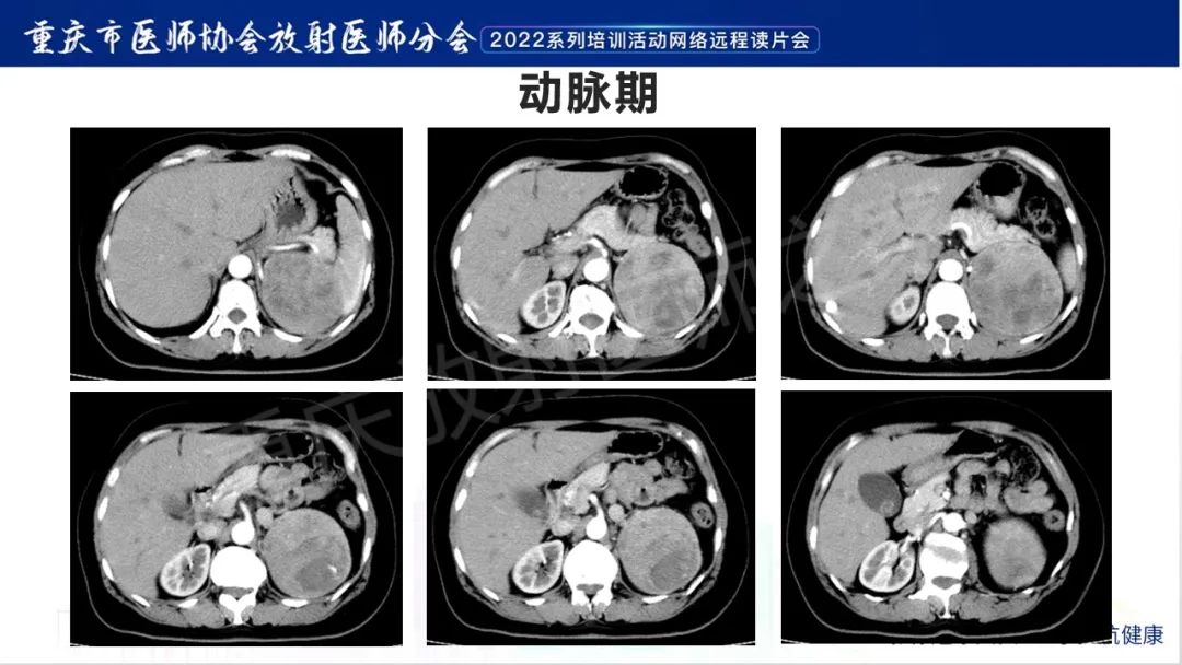 影像PPT - 【病例】肾上腺皮质嗜酸细胞腺瘤1例CT-4