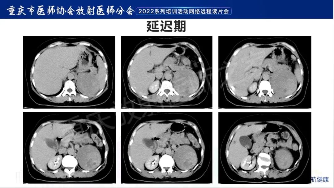 影像PPT - 【病例】肾上腺皮质嗜酸细胞腺瘤1例CT-6