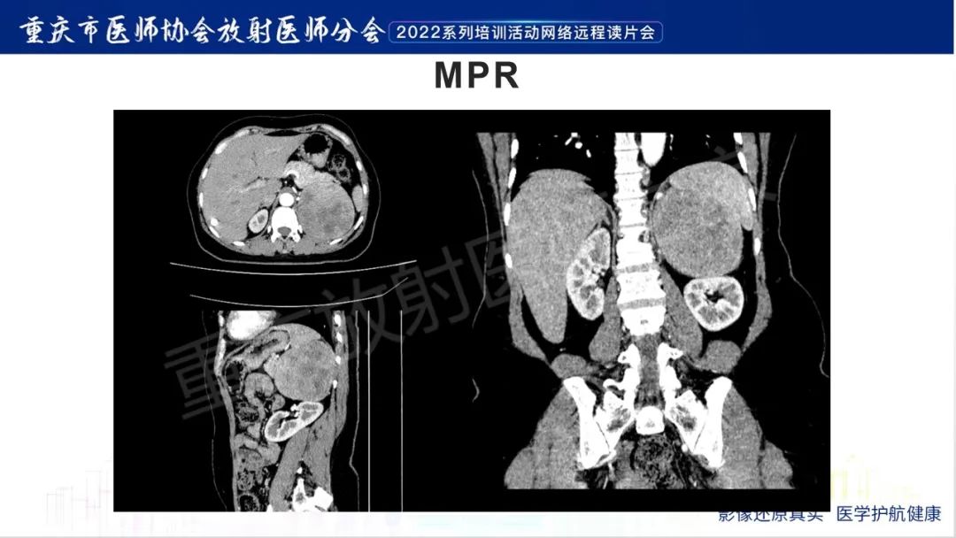影像PPT - 【病例】肾上腺皮质嗜酸细胞腺瘤1例CT-7