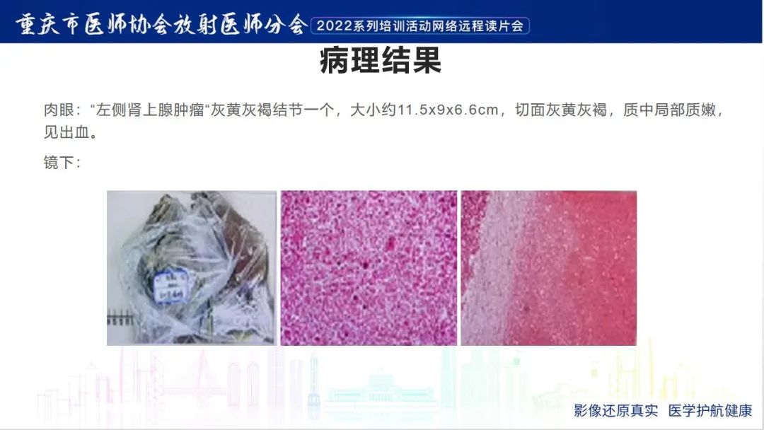 影像PPT - 【病例】肾上腺皮质嗜酸细胞腺瘤1例CT-11