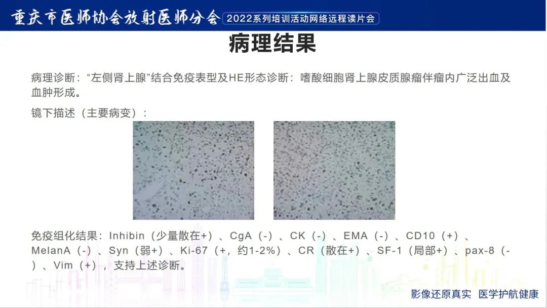 影像PPT - 【病例】肾上腺皮质嗜酸细胞腺瘤1例CT-12