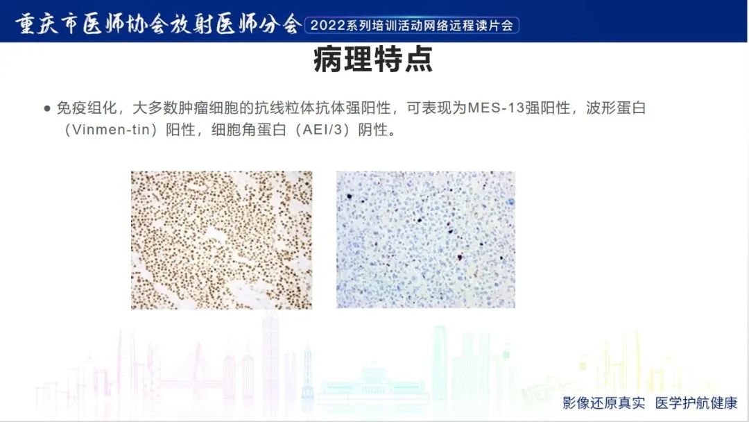 影像PPT - 【病例】肾上腺皮质嗜酸细胞腺瘤1例CT-16
